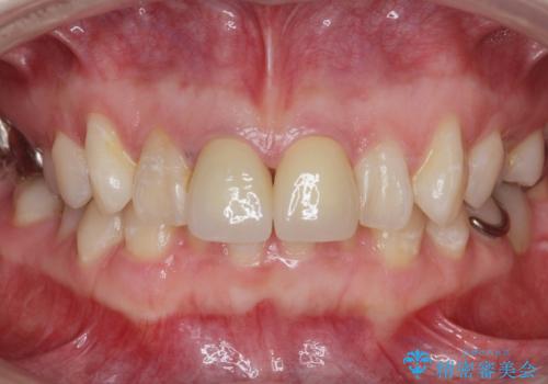 前歯の色が気になる。の治療後