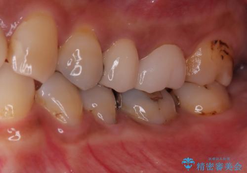 【根管治療・オールセラミッククラウン】何もしなくても歯が痛い 咬むと更に痛いの治療後