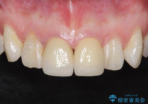 前歯の色が気になる。の症例 治療後