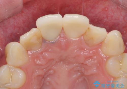 前歯の色が気になる。の治療後