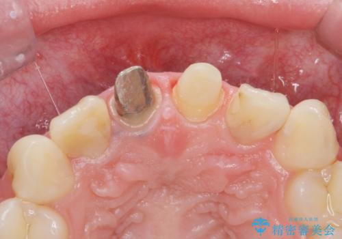 前歯の色が気になる。の治療中