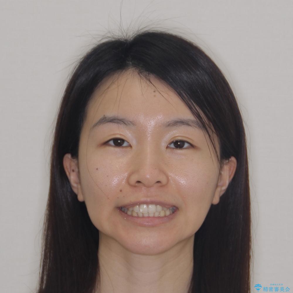 【モニター】前歯のデコボコとクロスバイト インビザラインによる矯正治療の治療後(顔貌)