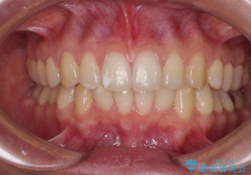 【モニター】前歯のデコボコとクロスバイト　インビザラインによる矯正治療