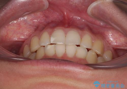 【モニター】前歯のデコボコとクロスバイト インビザラインによる矯正治療の治療後