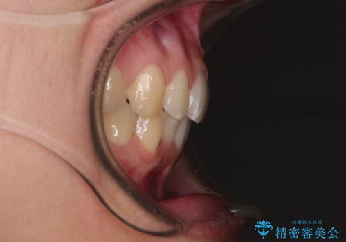 【モニター】前歯のデコボコとクロスバイト インビザラインによる矯正治療の治療後
