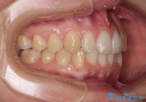 【モニター】前歯のデコボコとクロスバイト インビザラインによる矯正治療の治療後