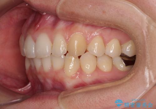 【モニター】前歯のデコボコとクロスバイト　インビザラインによる矯正治療の治療後