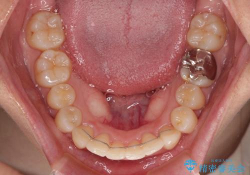 【モニター】前歯のデコボコとクロスバイト　インビザラインによる矯正治療の治療後