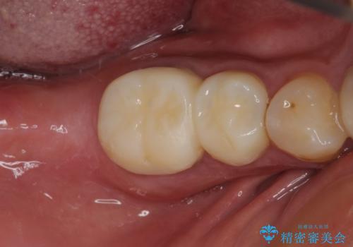 目立つ金属をすべてセラミックに 全顎的メタルフリー治療の治療前