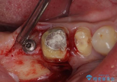 目立つ金属をすべてセラミックに 全顎的メタルフリー治療の治療中