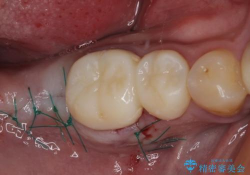 目立つ金属をすべてセラミックに 全顎的メタルフリー治療の治療後