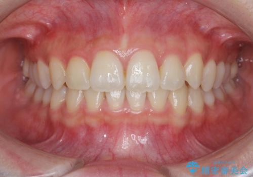 [ 鋏状咬合・過蓋咬合・上顎前突 ]  前歯のガタつき、噛みあわせのズレを矯正治療で改善の症例 治療後