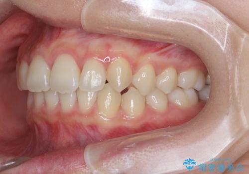 [ 鋏状咬合・過蓋咬合・上顎前突 ]  前歯のガタつき、噛みあわせのズレを矯正治療で改善の治療後