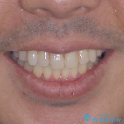 内側に転位した歯とボロボロのむし歯　インビザラインによる矯正治療とむし歯治療の治療後（顔貌）