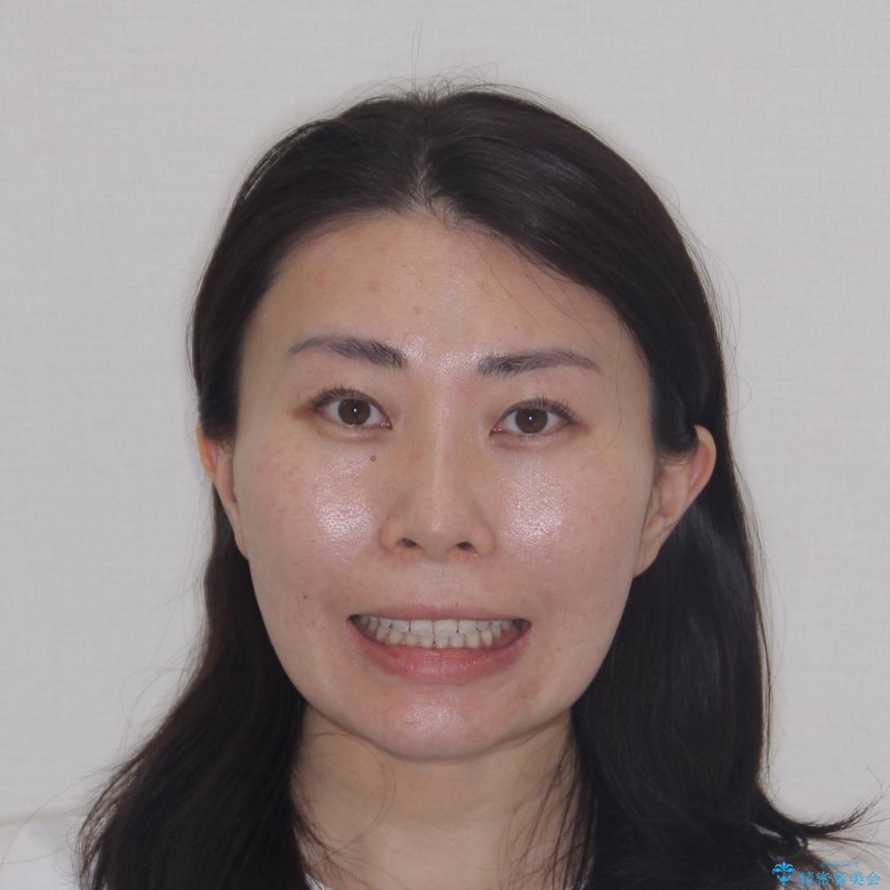 【モニター】ディープバイトを治す ワイヤー装置による矯正治療の治療後(顔貌)