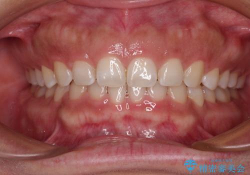 【モニター】ディープバイトを治す ワイヤー装置による矯正治療