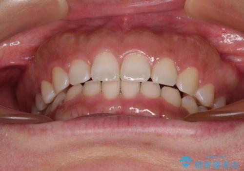 【モニター】ディープバイトを治す ワイヤー装置による矯正治療の治療後