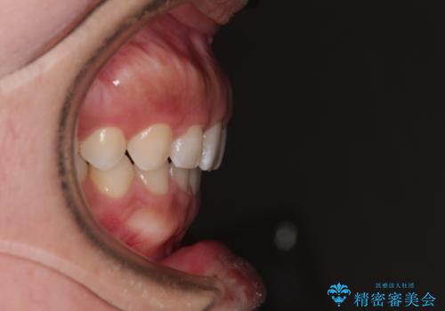 【モニター】ディープバイトを治す ワイヤー装置による矯正治療の治療後