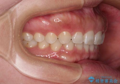 【モニター】ディープバイトを治す ワイヤー装置による矯正治療の治療後