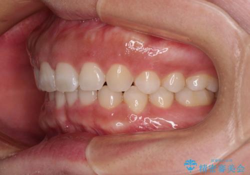 【モニター】ディープバイトを治す ワイヤー装置による矯正治療の治療後