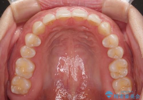 【モニター】ディープバイトを治す ワイヤー装置による矯正治療の治療後