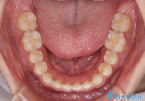 【モニター】ディープバイトを治す ワイヤー装置による矯正治療の治療後