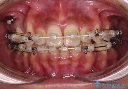 八重歯と出っ歯を治したい ワイヤー装置での抜歯矯正の治療中