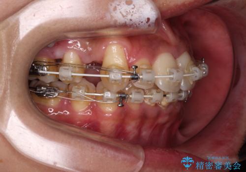 八重歯と出っ歯を治したい　ワイヤー装置での抜歯矯正の治療中