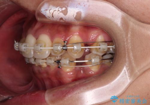 八重歯と出っ歯を治したい ワイヤー装置での抜歯矯正の治療中