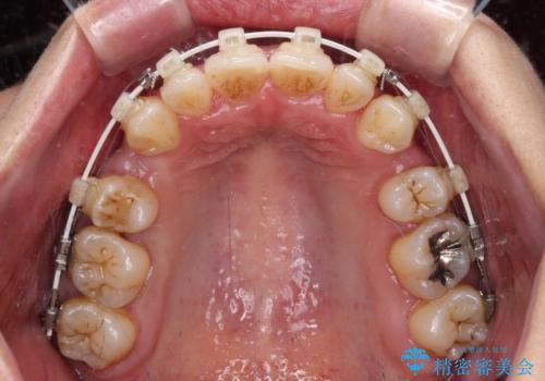 八重歯と出っ歯を治したい ワイヤー装置での抜歯矯正の治療中