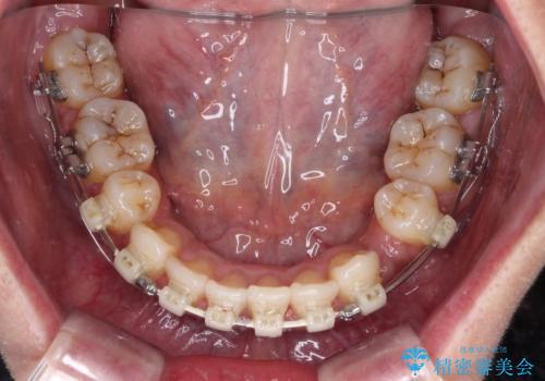 八重歯と出っ歯を治したい ワイヤー装置での抜歯矯正の治療中