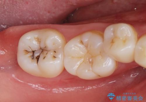 [セラミックインレー] 黒くなった歯の溝を白くしたいの症例 治療前