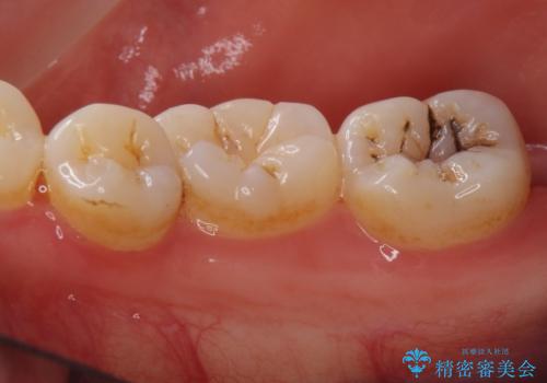 [セラミックインレー] 黒くなった歯の溝を白くしたいの治療前