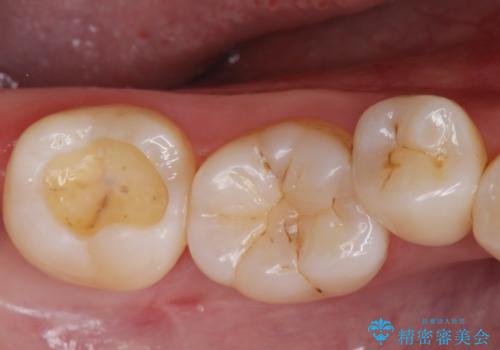 [セラミックインレー] 黒くなった歯の溝を白くしたいの治療中