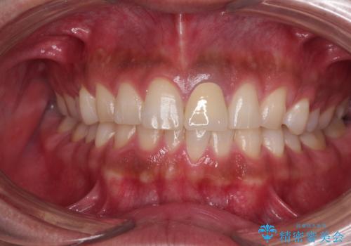 変色した前歯をオールセラミッククラウンにの治療後