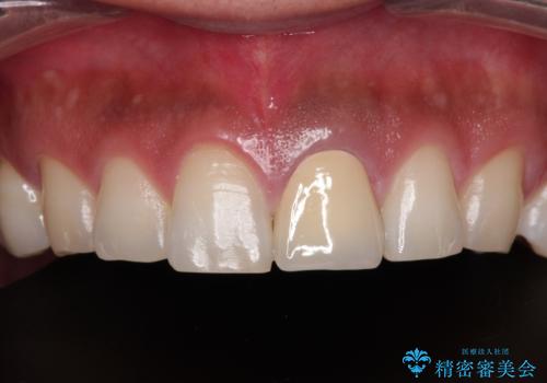 変色した前歯をオールセラミッククラウンにの治療後