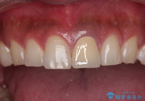 変色した前歯をオールセラミッククラウンにの治療後