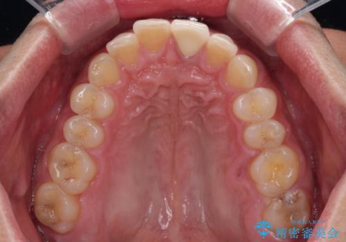 変色した前歯をオールセラミッククラウンにの治療後