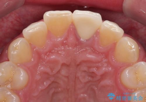 変色した前歯をオールセラミッククラウンにの治療後