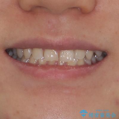 隙間とデコボコを治したい ワイヤー装置による矯正治療の治療前(顔貌)