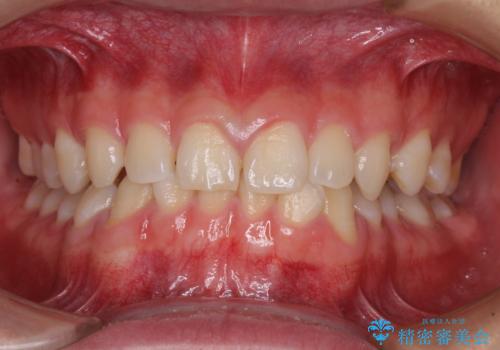 隙間とデコボコを治したい ワイヤー装置による矯正治療の症例 治療前