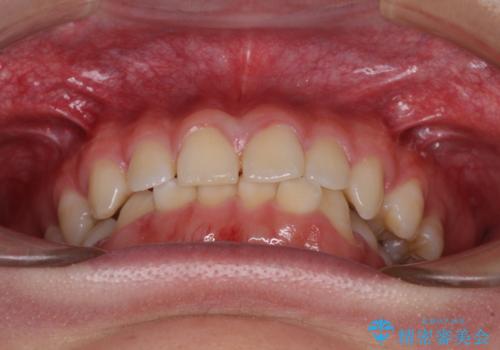 隙間とデコボコを治したい ワイヤー装置による矯正治療の治療前