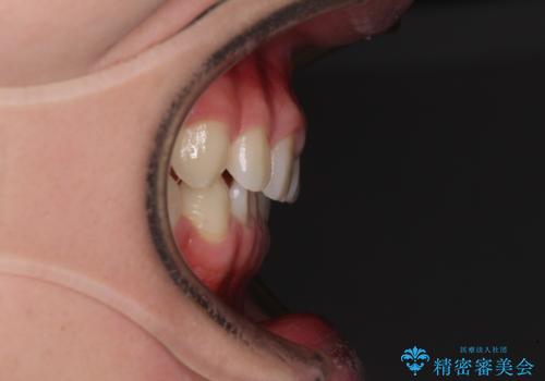 隙間とデコボコを治したい ワイヤー装置による矯正治療の治療前