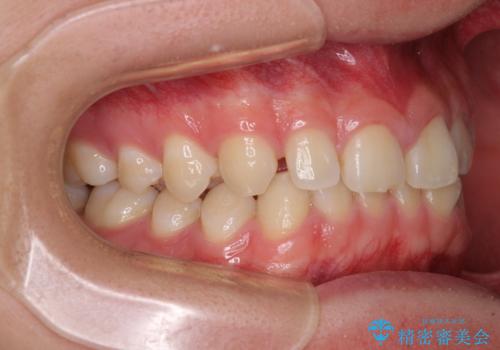 隙間とデコボコを治したい ワイヤー装置による矯正治療の治療前