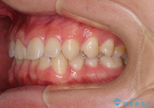 隙間とデコボコを治したい ワイヤー装置による矯正治療の治療前