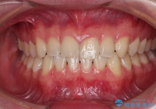 隙間とデコボコを治したい ワイヤー装置による矯正治療の症例 治療後