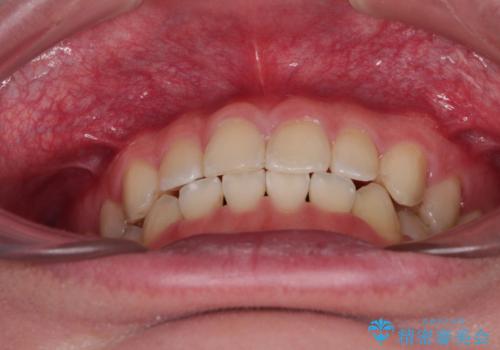 隙間とデコボコを治したい ワイヤー装置による矯正治療の治療後