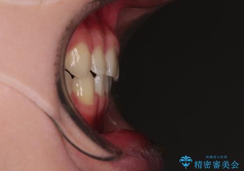 隙間とデコボコを治したい ワイヤー装置による矯正治療の治療後