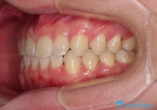 隙間とデコボコを治したい ワイヤー装置による矯正治療の治療後