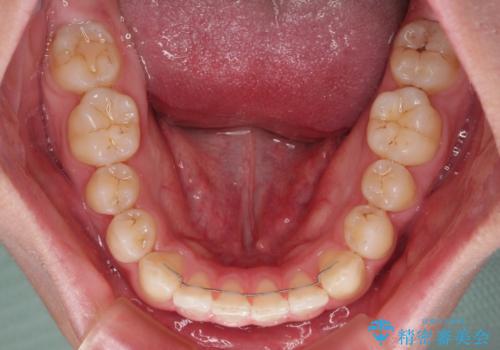 隙間とデコボコを治したい ワイヤー装置による矯正治療の治療後